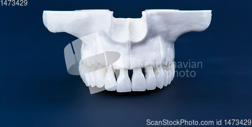 Image of Upper human jaw with teeth