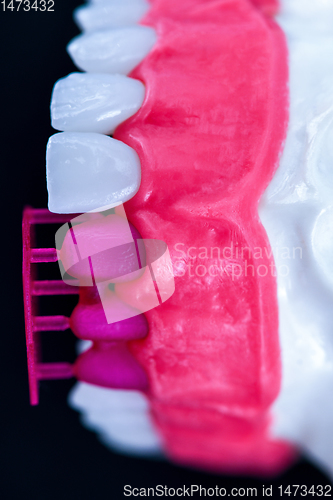 Image of Tooth implant and crown installation process