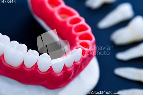 Image of Tooth implant and crown installation process