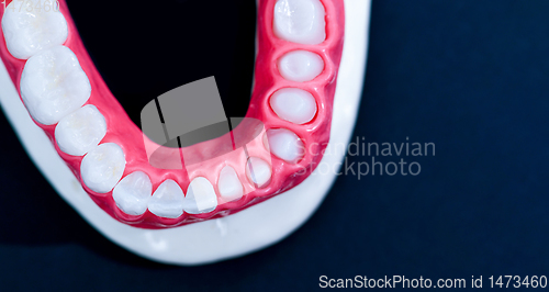 Image of Tooth implant and crown installation process