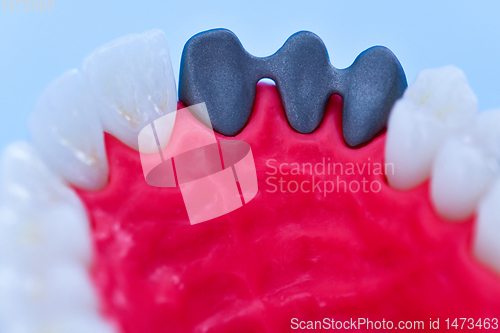 Image of Tooth implant and crown installation process