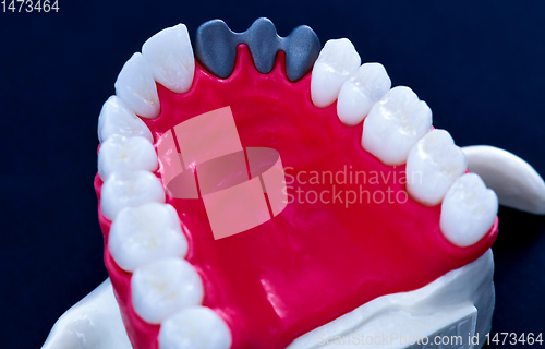 Image of Tooth implant and crown installation process