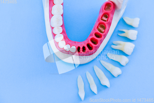 Image of Tooth implant and crown installation process