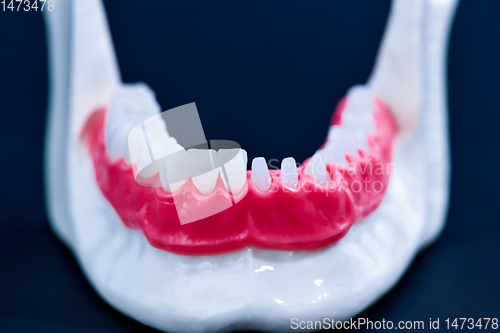 Image of Tooth implant and crown installation process