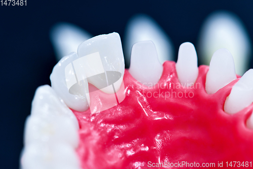 Image of Tooth implant and crown installation process