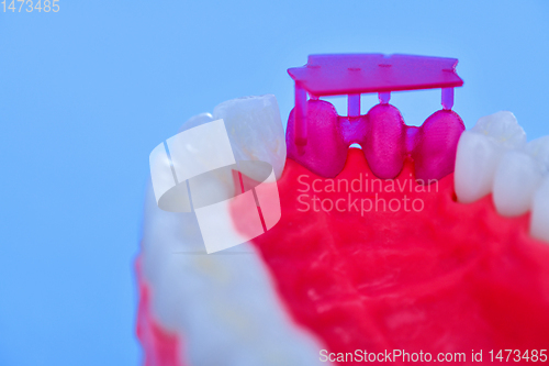 Image of Tooth implant and crown installation process