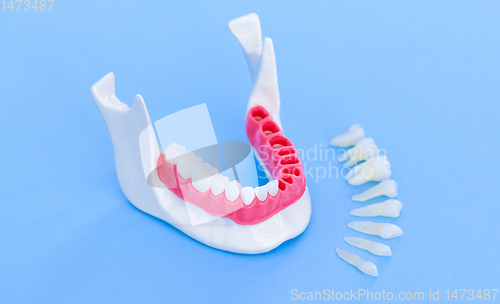 Image of Tooth implant and crown installation process