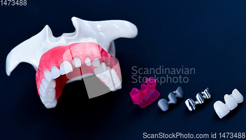 Image of Tooth implant and crown installation process