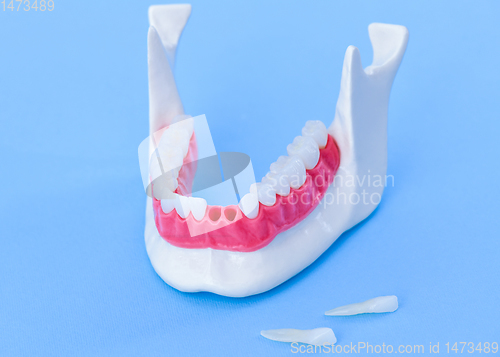 Image of Tooth implant and crown installation process