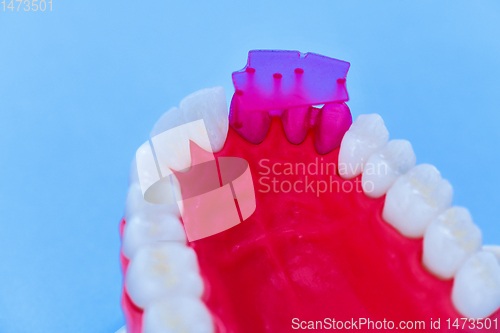 Image of Tooth implant and crown installation process