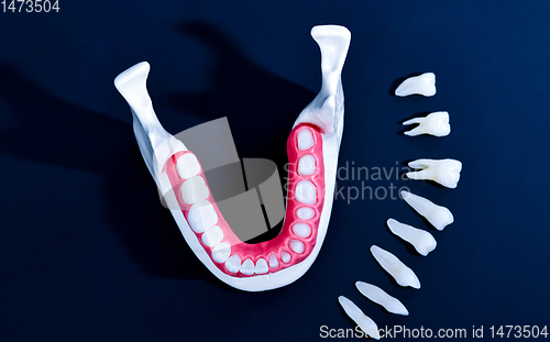 Image of Tooth implant and crown installation process