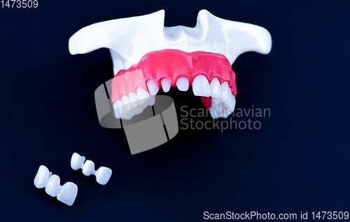 Image of Tooth implant and crown installation process