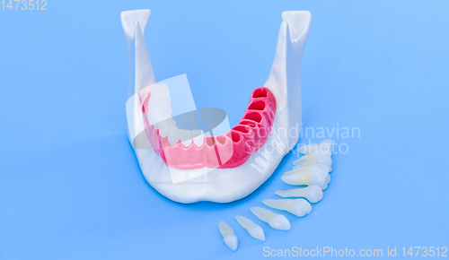 Image of Tooth implant and crown installation process