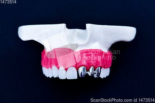 Image of Tooth implant and crown installation process