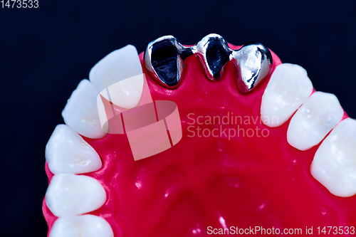 Image of Tooth implant and crown installation process