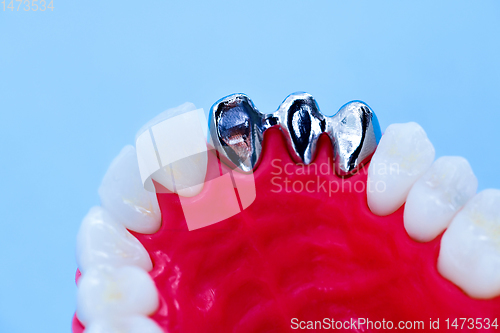 Image of Tooth implant and crown installation process