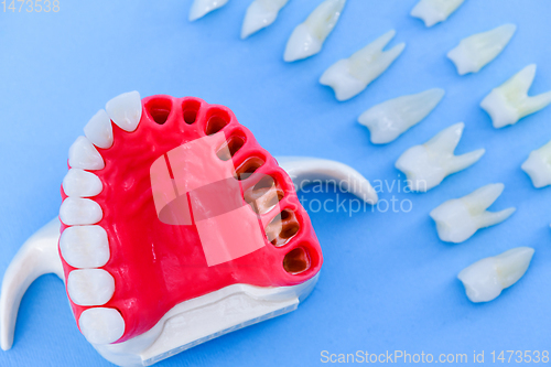 Image of Tooth implant and crown installation process