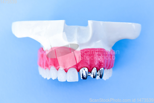 Image of Tooth implant and crown installation process