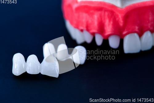 Image of Tooth implant and crown installation process