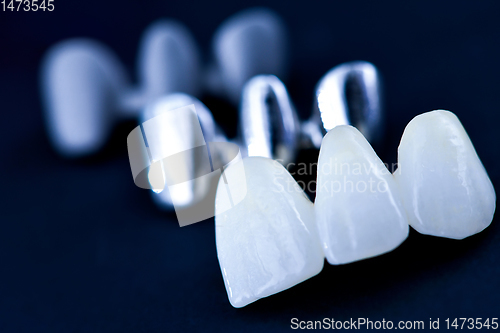Image of different types of dental tooth crowns