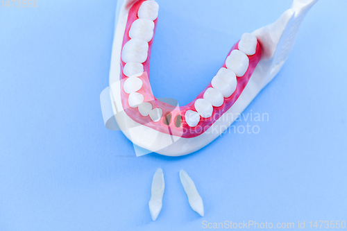 Image of Tooth implant and crown installation process