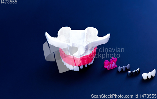 Image of Tooth implant and crown installation process