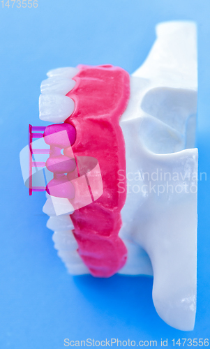 Image of Tooth implant and crown installation process