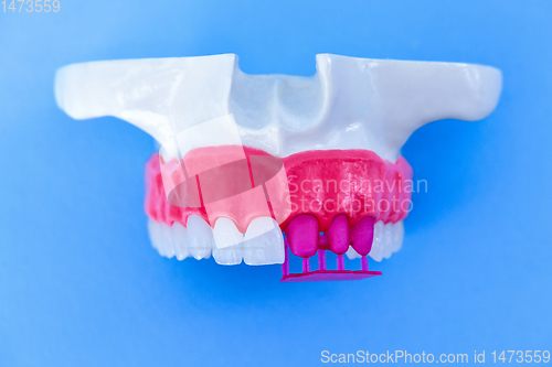 Image of Tooth implant and crown installation process