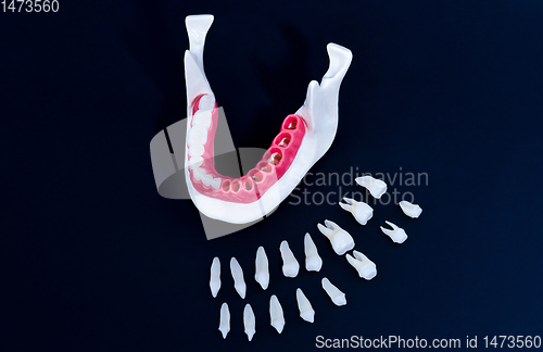 Image of Tooth implant and crown installation process