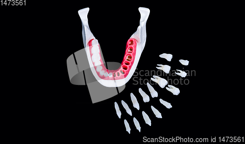 Image of Tooth implant and crown installation process