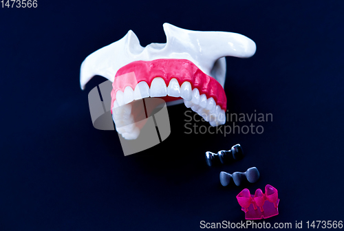 Image of Tooth implant and crown installation process