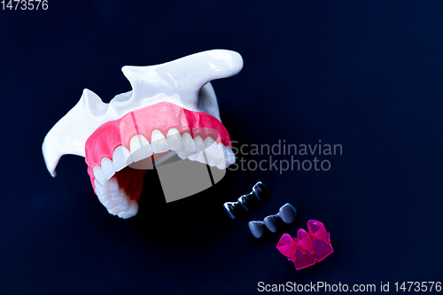 Image of Tooth implant and crown installation process