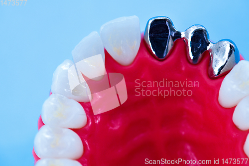 Image of Tooth implant and crown installation process