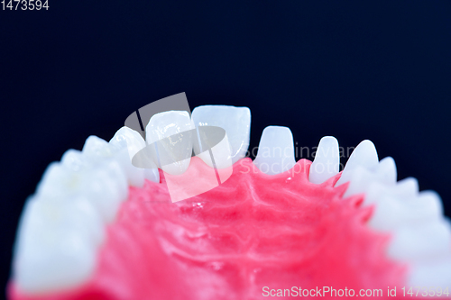 Image of Tooth implant and crown installation process