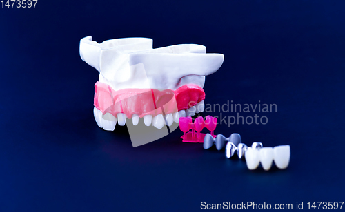 Image of Tooth implant and crown installation process