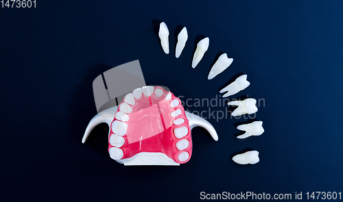 Image of Tooth implant and crown installation process