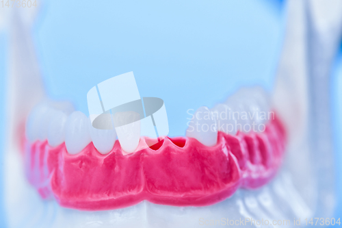 Image of Tooth implant and crown installation process