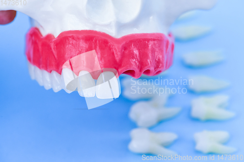 Image of Tooth implant and crown installation process