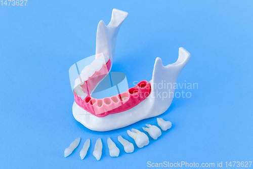 Image of Tooth implant and crown installation process