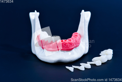 Image of Tooth implant and crown installation process