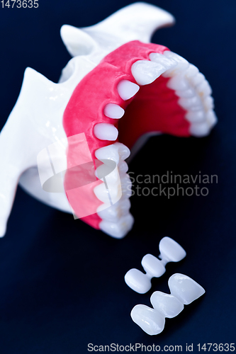 Image of Tooth implant and crown installation process