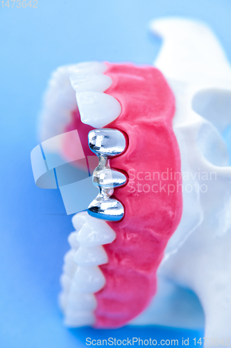 Image of Tooth implant and crown installation process