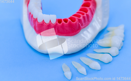 Image of Tooth implant and crown installation process