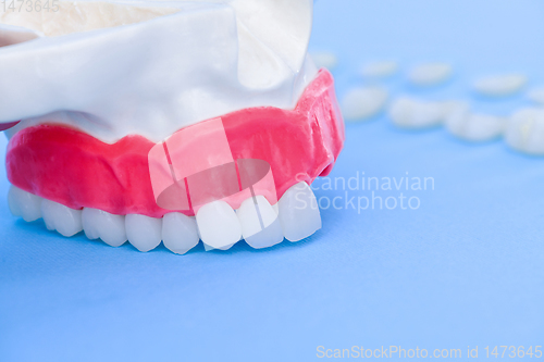 Image of Tooth implant and crown installation process