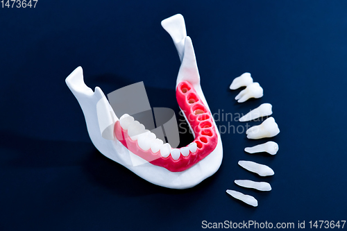 Image of Tooth implant and crown installation process