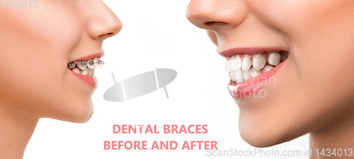 Image of Close up female portrait, dental braces before and after