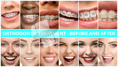 Image of Beautiful close up portraits, concept of teeth treatment