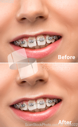 Image of Close up female portrait, dental braces before and after