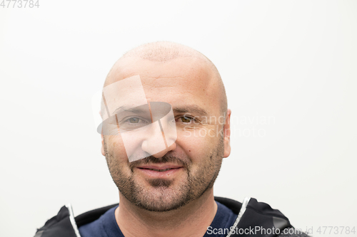 Image of man after hair implant therapy