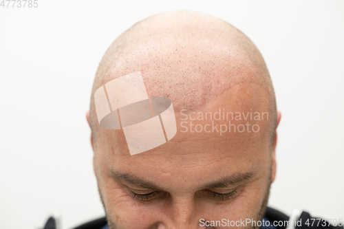 Image of man after hair implant therapy